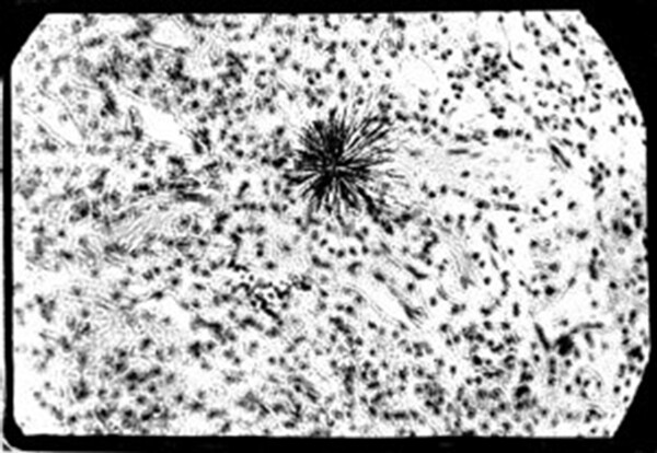 Particle of Plutonium in lung tissue of an ape. Alpha radiation Particle of plutonium in lung tissue. The black streaks in the middle of this picture are tracks made by alpha particles emitted from plutonium embedded in the lung of an ape. Alpha particles do not travel far but if inhaled or eaten can damage more than 10,000 cells within their range, and are among the deadliest of radioactive materials. Cesium-137, now being found in Pacific tuna because of Fukushima, emits beta particles which are even more penetrating than alpha particles. Photo: Lawrence Livermore Laboratory, Berkeley, CA. 
